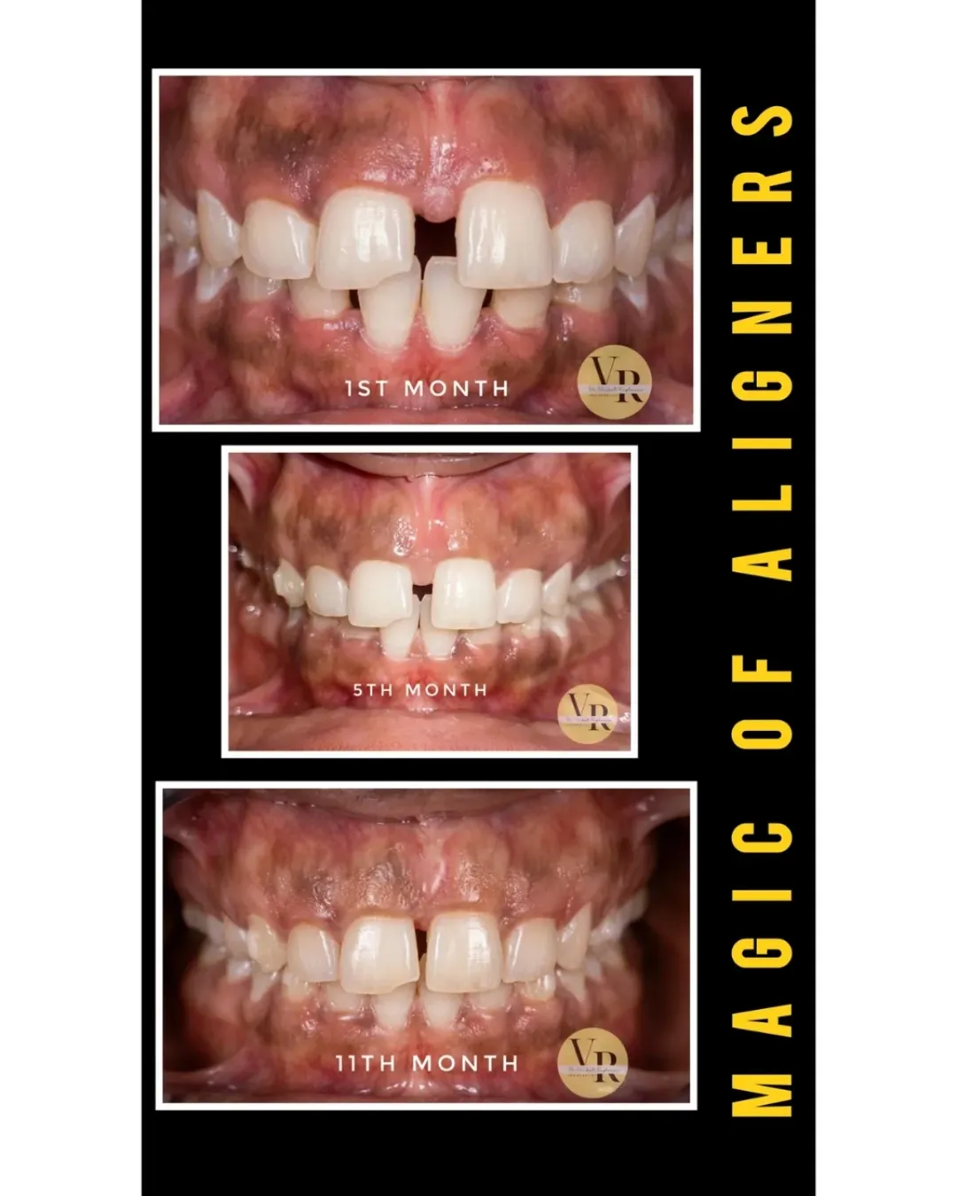 Magic of Aligners