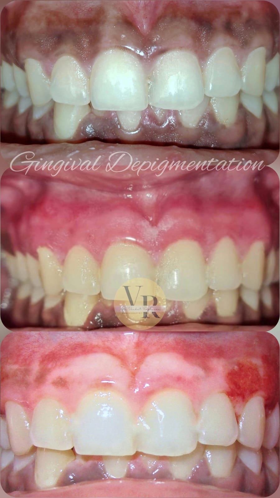 Magic of Aligners Progress