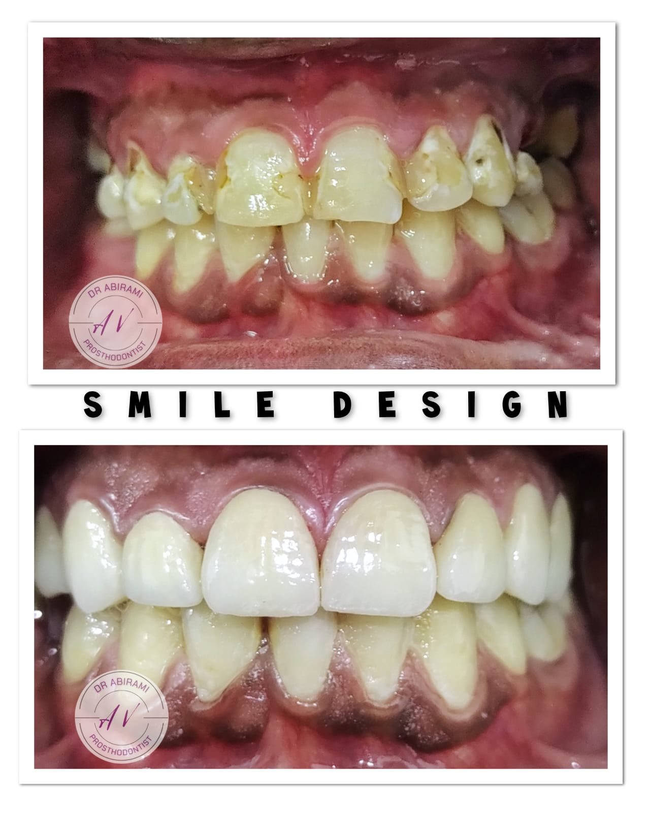 Gingival Depigmentation