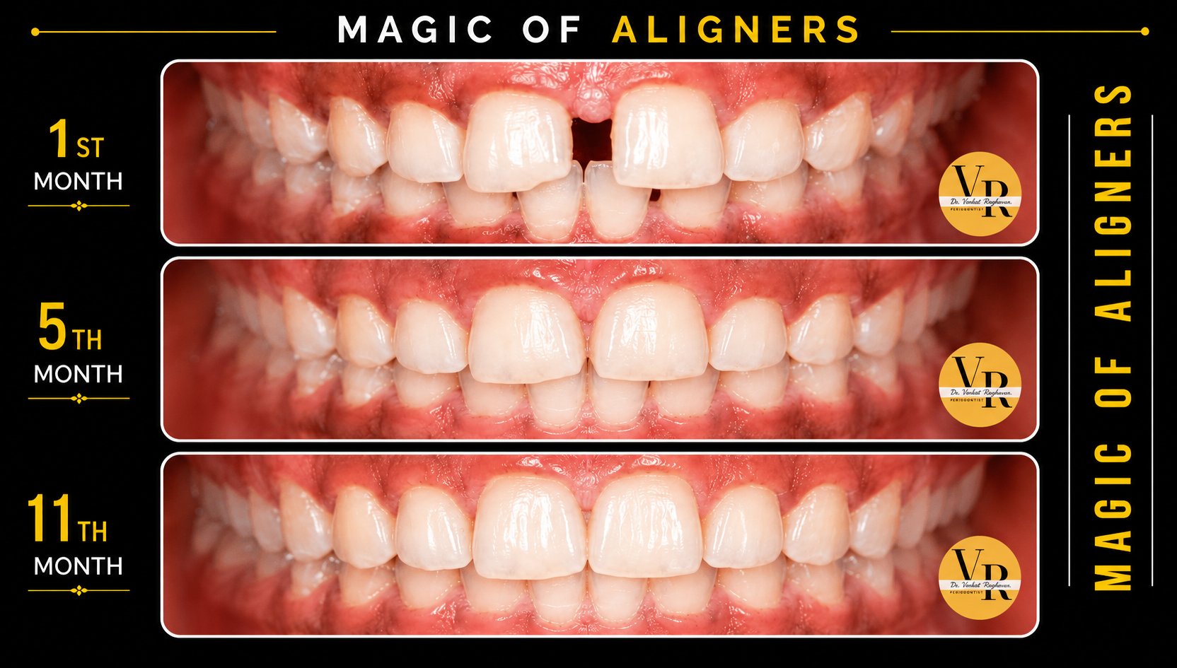 Invisible Aligners