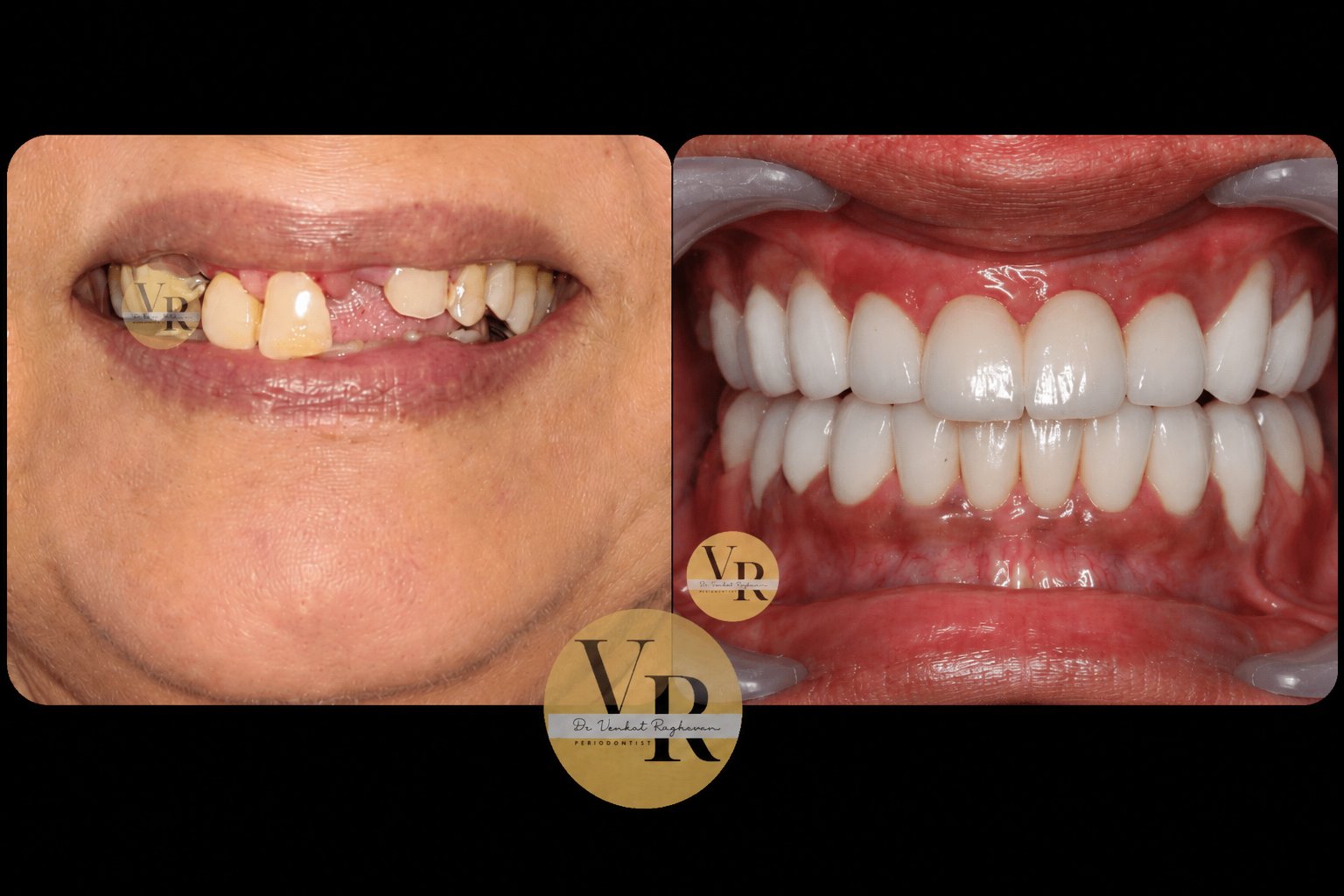 Full Mouth Rehabilitation
