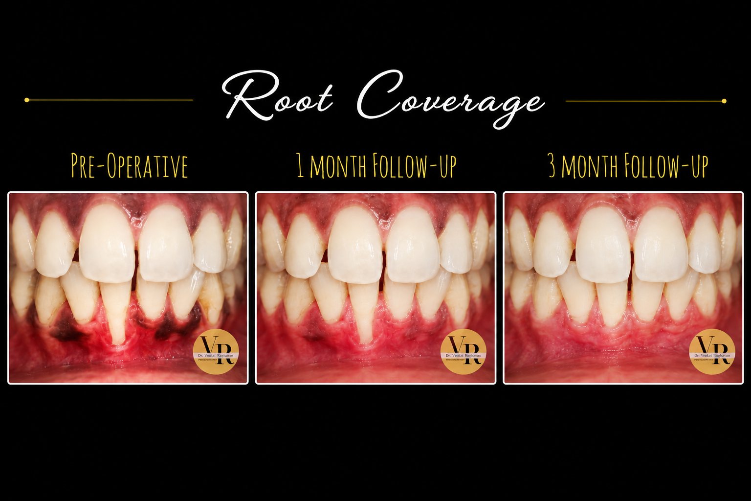 Gum & Bone Treatment