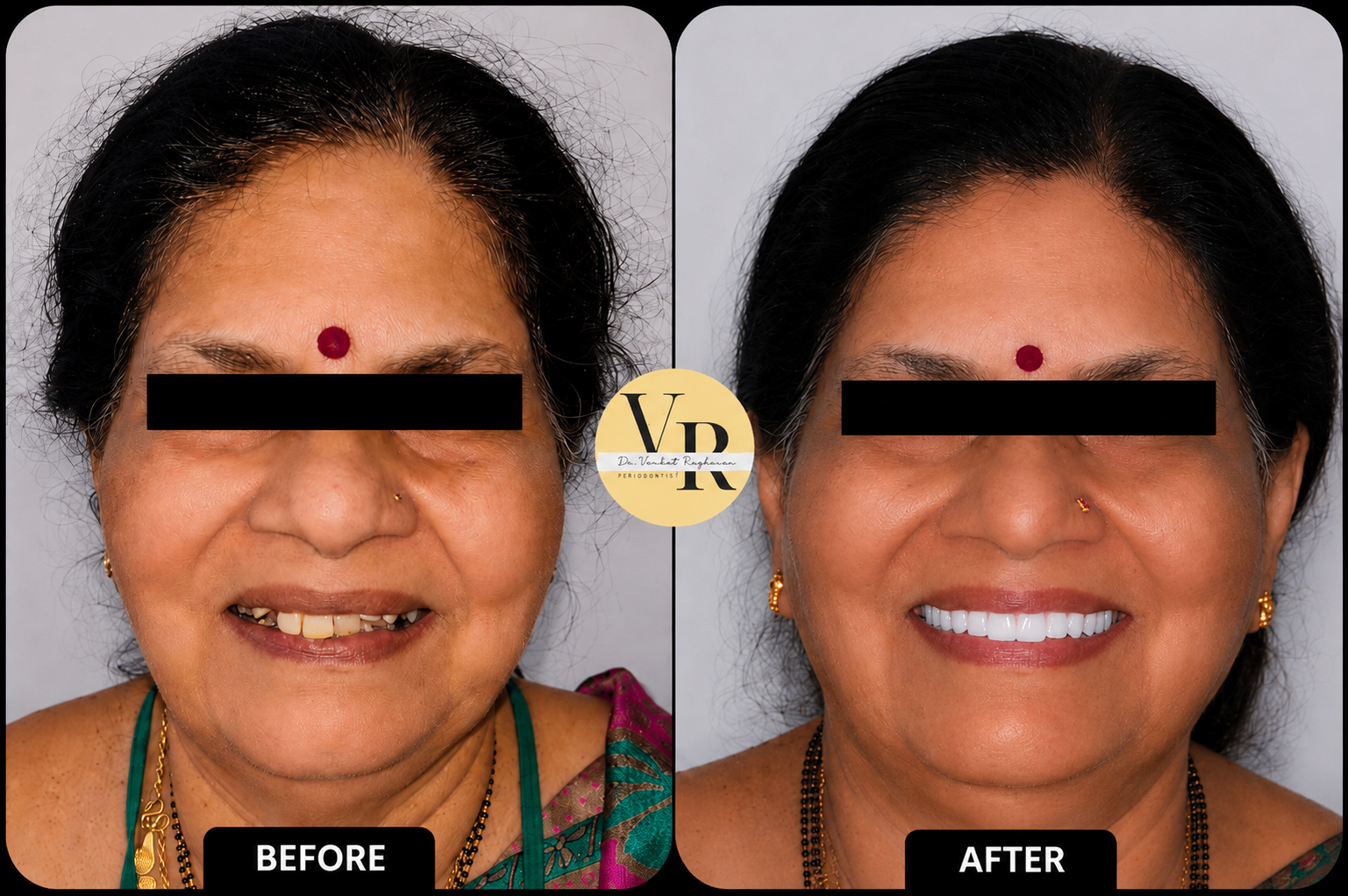 Smile Designing